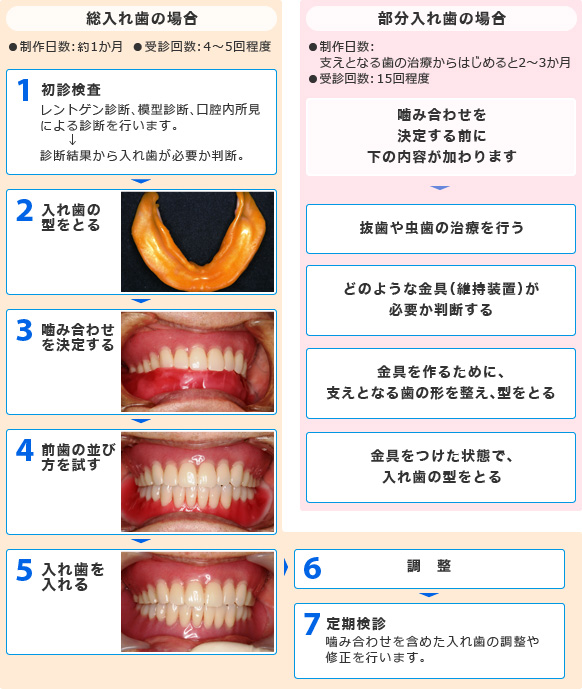 総入れ歯、部分入れ歯の完成までの流れ